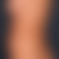 Pityriasis rosea:&nbsp;stammbetontes, in den Spaltlinien angeordnetes díchtes makulopapulöses Exa...