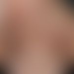 Pityriasis rosea:&nbsp;truncated, thick maculopapular exanthema arranged in the cleft lines, low ...