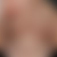 Pityriasis rosea:&nbsp;stammbetontes, in den Spaltlinien angeordnetes, díchtes makulopapulöses Ex...