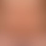 Pityriasis rosea. truncated, díchtes maculopapular exanthema arranged in the cleft lines, little ...