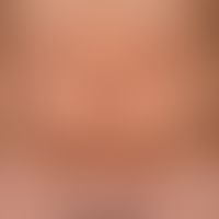 Pityriasis rosea: stammbetontes, in den Spaltlinien angeordnetes, dichtes, makulopapulöses Exanth...