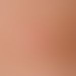 Pityriasis rosea. truncated, díchtes maculopapular exanthema arranged in the cleft lines, low itc...