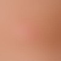 Pityriasis rosea. Stammbetontes, in den Spaltlinien angeordnetes díchtes makulopapulöses Exanthem...
