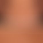 Pityriasis versicolor alba: vertikale Pfeile bezeichen die befallene &nbsp;(depigmentierte) Haut....