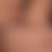 Parapsoriasis en petites plaques: In den Hautspaltlinien ausgerichtete gering schuppende, symptom...