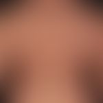 Parapsorisis en petites plaques: Non-symptomatic (no itching) red (hardly palpable), slightly sca...