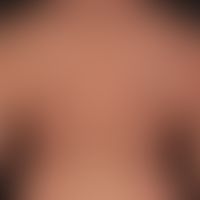 Parapsorisis en petites plaques: Non-symptomatic (no itching) red (hardly palpable), slightly sca...