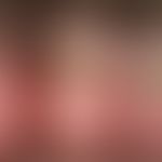 Pincer-nail: 3. Zehe. Kneifzangenartige Umfassung des Nagelbettes durch den verkrümmten und verdi...