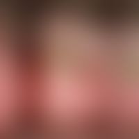 Pincer-nail: 3. Zehe. Kneifzangenartige Umfassung des Nagelbettes durch den verkrümmten und verdi...