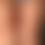 Pityriasis lichenoides et varioliformis acuta. multiple, since 1 week existing, disseminated, 0.2...