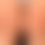 Pityriasis lichenoides et varioliformis acuta. 15-month-oldchild. 0.2-0.4 cm large, symmetrically...
