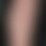 Pityriasis lichenoides chronica:&nbsp;seit mehreren Monaten bestehendes, gering juckendes makulo-...