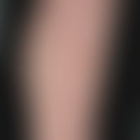 Pityriasis lichenoides chronica:&nbsp;seit mehreren Monaten bestehendes, gering juckendes makulo-...