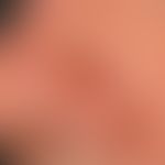 Keratoakanthom klassischer Typ: 6 Jahre alter Patient. Ausbidung dieses 1,1 cm im Durchmesser gro...