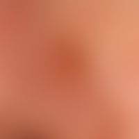 Keratoakanthom klassischer Typ: Seitenansicht des vorschriebenen Keratokanthoms.
