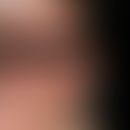Keratosis pilaris-Syndrom: auffällgie symmetrische Rötung beider Wangen. Ausgeprägtes&nbsp; Ulery...