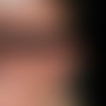 Keratosis pilaris syndrome: conspicuous symmetrical redness of both cheeks; distinct ulerythema o...