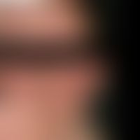 Keratosis pilaris syndrome: conspicuous symmetrical redness of both cheeks; distinct ulerythema o...