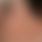 Erythema perstans faciei:&nbsp;persistierende, symptomarme, symmetrisch angeordnete Gesichtsrötun...