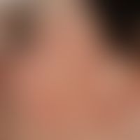 Erythema perstans faciei:&nbsp;persistierende, symptomarme, symmetrisch angeordnete Gesichtsrötun...