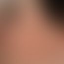 Keratosis follicularis spinulosa decalvans mit Ausbildung eines persistierenden Eryhems im Wangen...