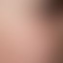 Atrophodermia vermiculata: 10-jähriges Mädchen mit beidseitig symmetrisch auftretenden, kleinsten...