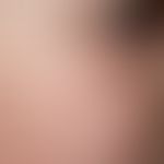 Atrophodermia vermiculata: 10-year-old girl with symmetrically appearing, smallest, reticulated f...