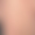 Comedone-like keratosis follicularis (see there): in contrast to classical comedones, keratosis f...
