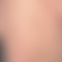 Comedone-like keratosis follicularis (see there): in contrast to classical comedones, keratosis f...