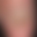 Squamous cell carcinoma of the skin: carcinoma of the nail bed that has been present for several ...