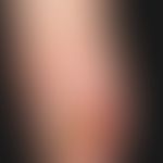 Squamous cell carcinoma of the skin: slowly growing, wart-like, painful, ulcerated and weeping no...