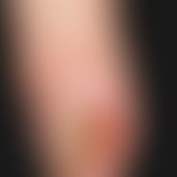 Squamous cell carcinoma of the skin: slowly growing, wart-like, painful, ulcerated and weeping no...