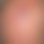Squamous cell carcinoma in actinic pre-damaged scalp:Continuously growing keratoacanthoma of the ...