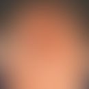 Squamous cell carcinoma in actinic pre-damaged scalp:Continuously growing verrucous, broad-based,...