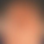 Squamous cell carcinoma in actinic pre-damaged scalp:Continuously growing verrucous, broad-based,...