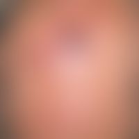 Aktinische Keratosen mit Keratoakanthom-ähnlichem Plattenepithelkarziom.&nbsp;Flächenhafte "Feldk...