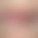 Lip carcinoma : Broad, firm, painless, warty, roughly indurated, eroded and ulcerated plaque and ...