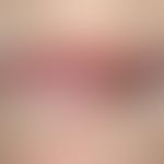 Lip carcinoma : Broad, firm, painless, warty, roughly indurated, eroded and ulcerated plaque and ...