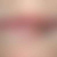 Lip carcinoma : Broad, firm, painless, warty, roughly indurated, eroded and ulcerated plaque and ...
