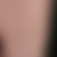Keratosis pilaris (follicularis): entzündliche, follikulär gebundene Hornpapeln am Unterschenkel....