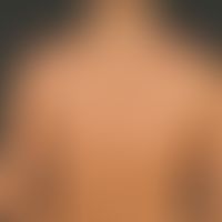 Keloide:&nbsp;seit der Pubertät bekannte inzwischen abgeheilte Acne vulgaris. Seit Monaten Entwic...