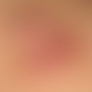 Keloids: bulbous conglomerates of solid, surface-smooth, skin-coloured and also reddish, broad-ba...