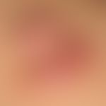 Keloid: wulstige Konglomerate von festen oberflächenglatten, hautfarbenen auch rötlichen, breitba...