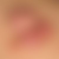 Keloids: bulbous conglomerates of solid, surface-smooth, skin-coloured and also reddish, broad-ba...