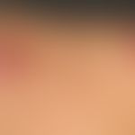 Kerloid: Keloide und hautfarbene, hypertrophe Narben nach abgeheilter Akne.
