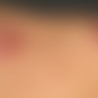 Kerloid: Keloide und hautfarbene, hypertrophe Narben nach abgeheilter Akne.
