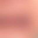 Varikose, sublinguale. Weiche, schmerzlose, bläuliche Venenkonglomerate an der Zungenunterseite (...
