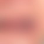 Varikose, sublinguale. Weiche, schmerzlose, bläuliche Venenkonglomerate an der Zungenunterseite (...
