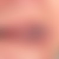 Varikose, sublinguale. Weiche, schmerzlose, bläuliche Venenkonglomerate an der Zungenunterseite (...