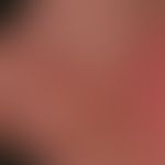 Comedo: multiple, chronically stationary, 0.5-1 mm large, firm, asymptomatic, grey, rough follicu...